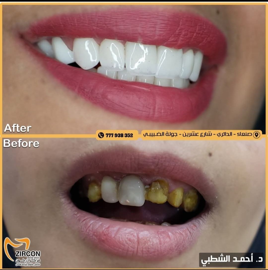 تصميم الابتسامة