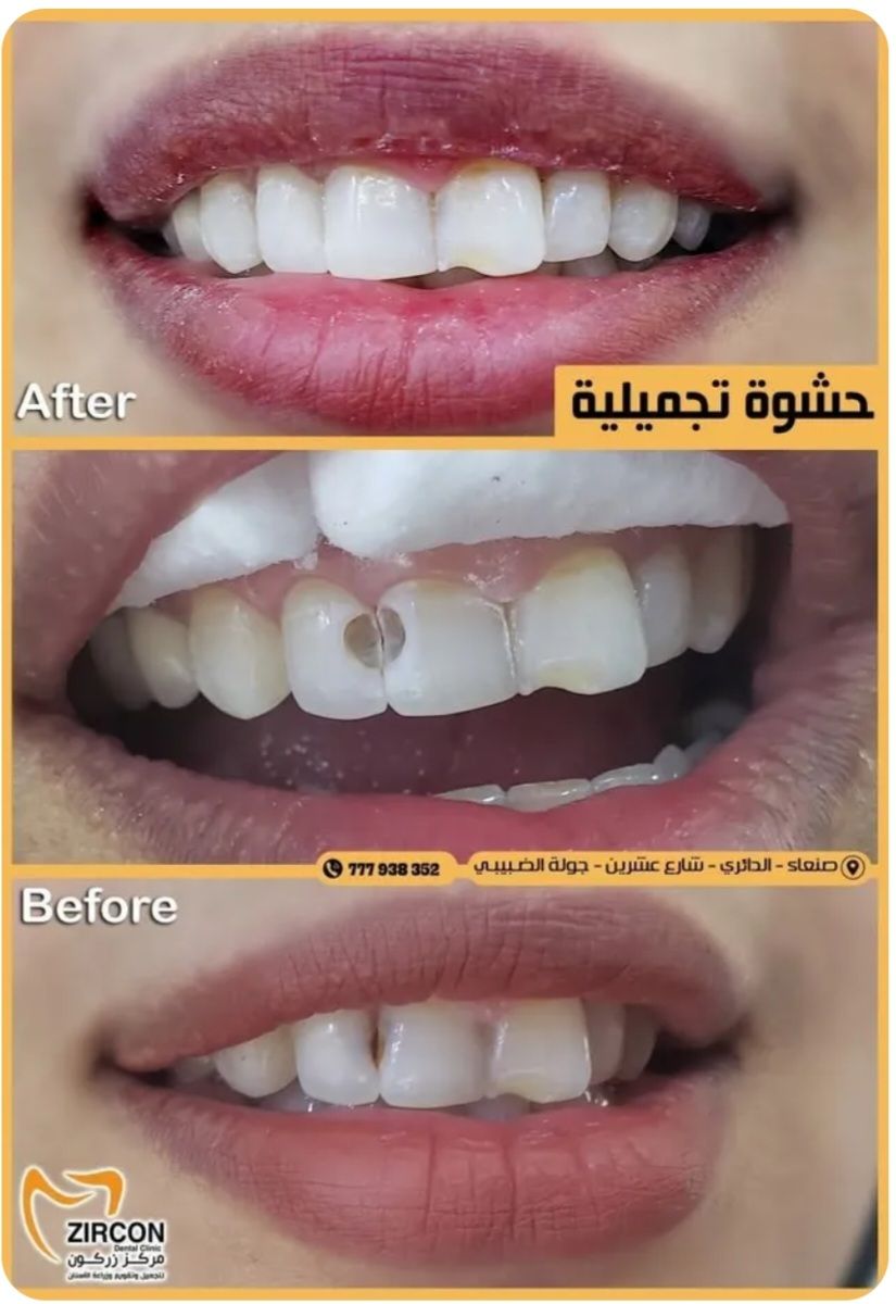 انواع حشوات الاسنان
