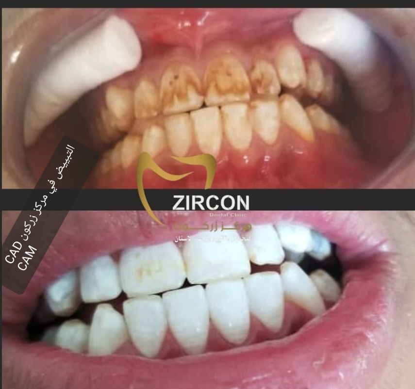 Clear Aligners Technology