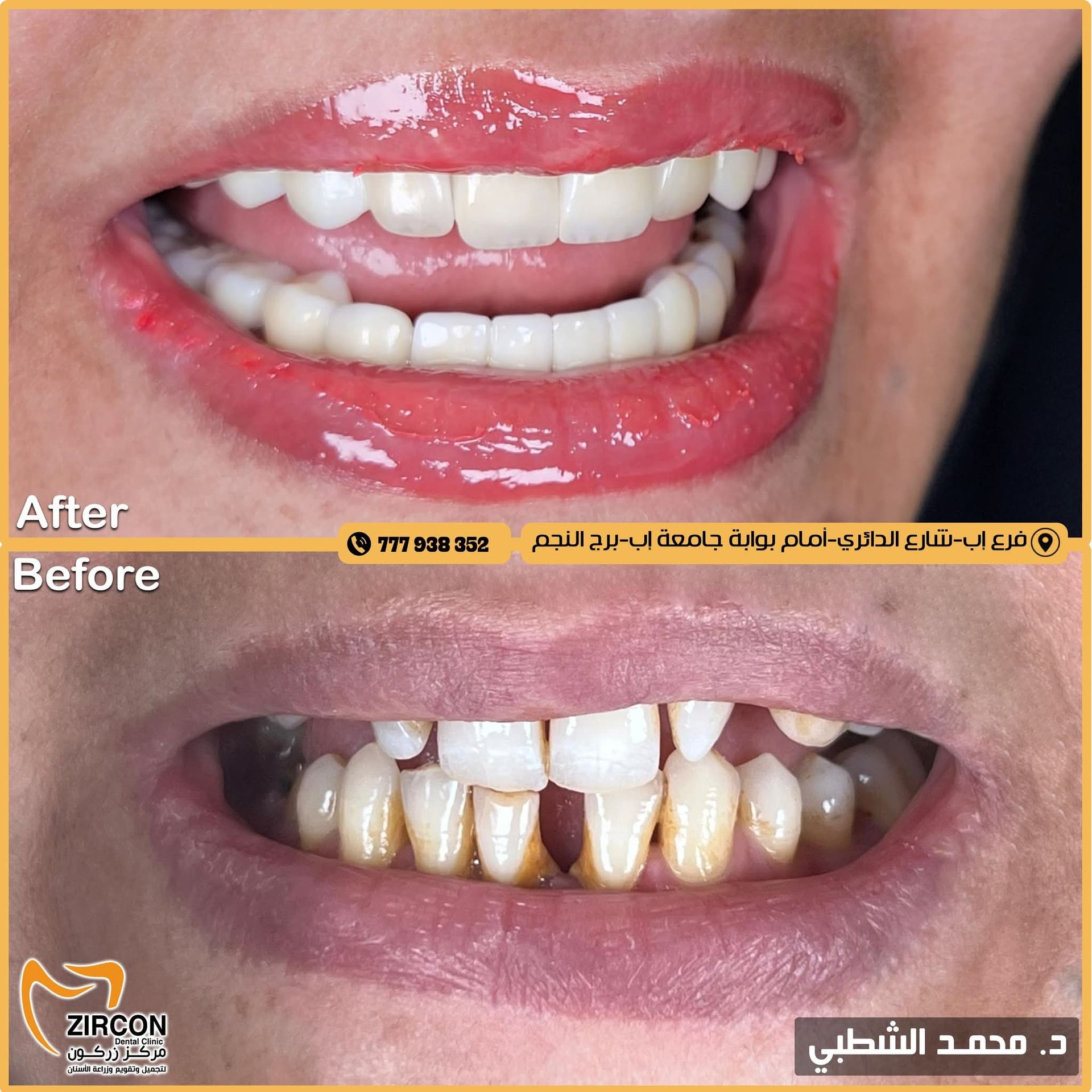 تجميل الأسنان - حالة 2