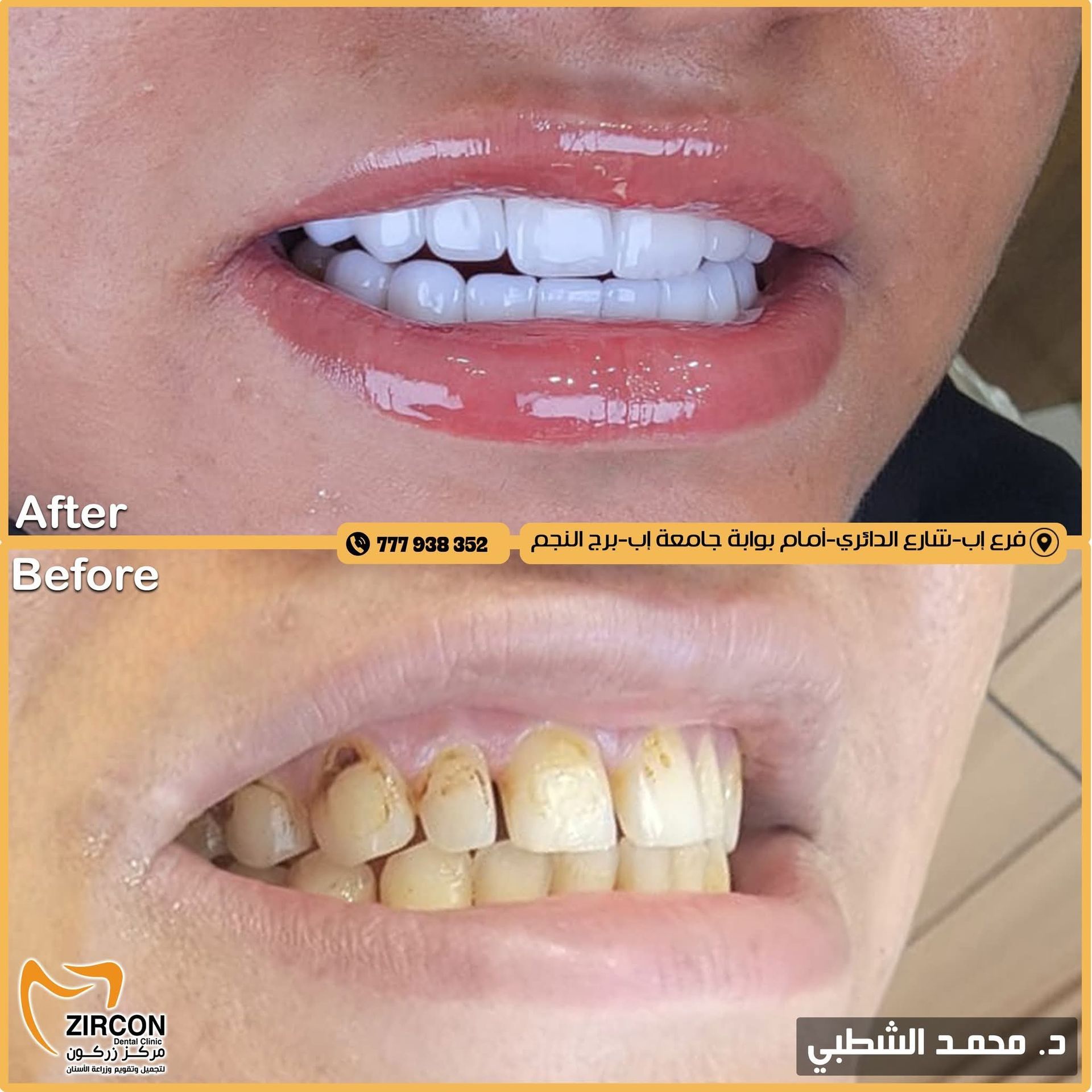 تجميل الأسنان - حالة 1