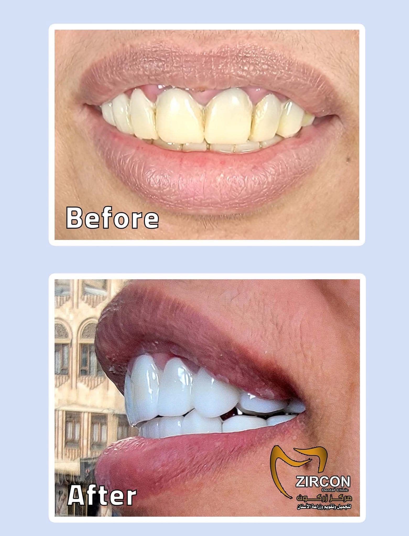 تجميل الأسنان - حالة 3