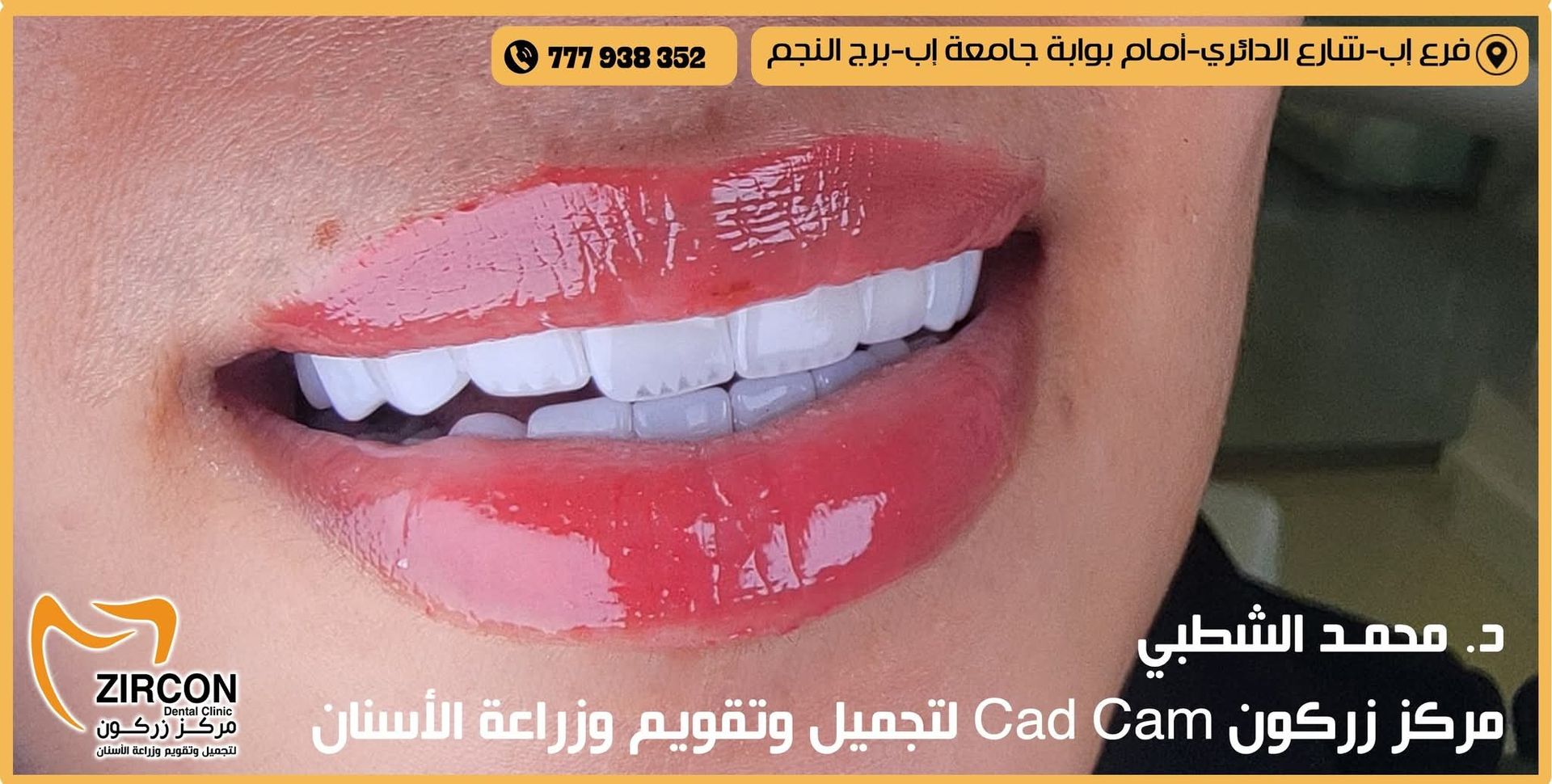 تجميل الأسنان - حالة 4