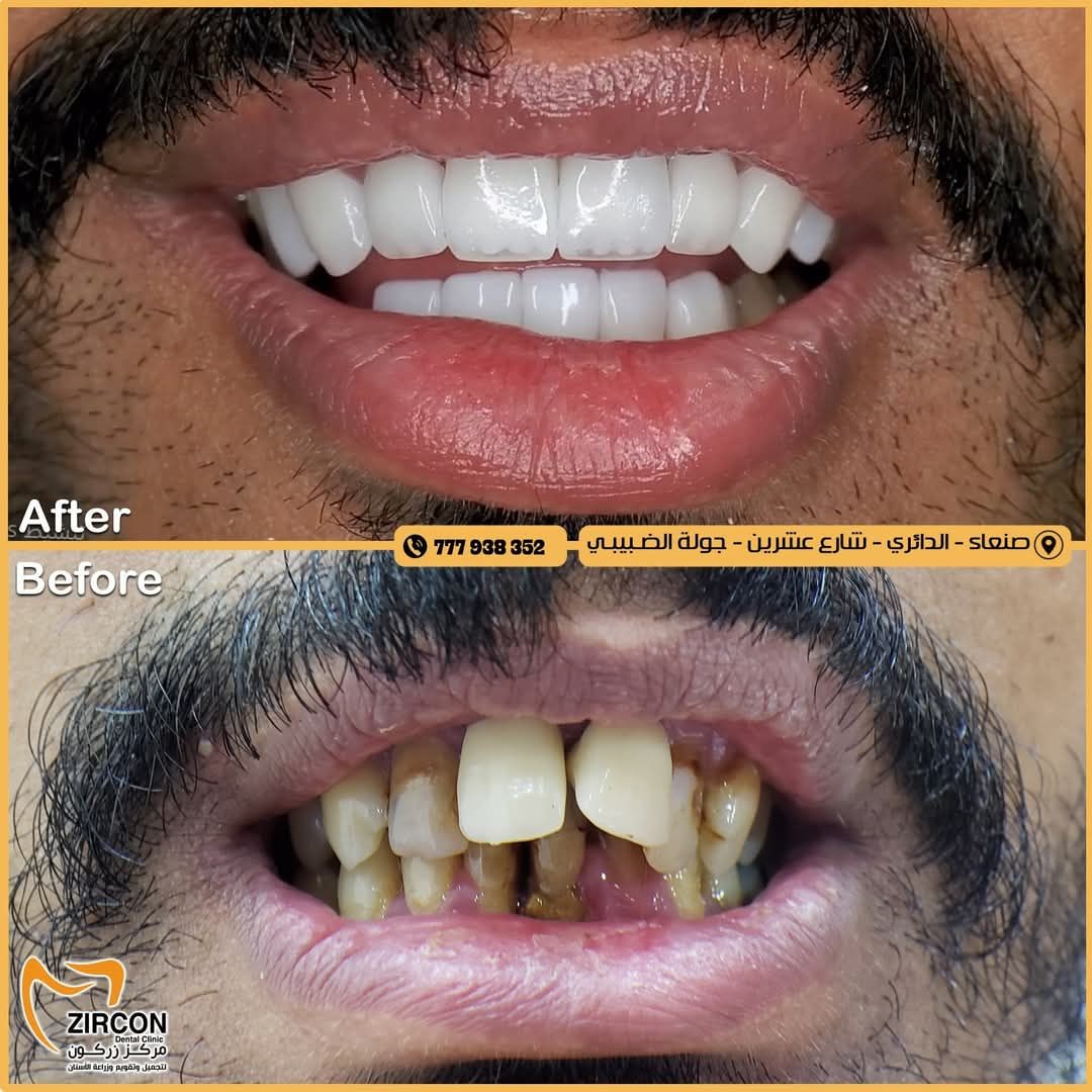 Zirconia Crown Manufacturing