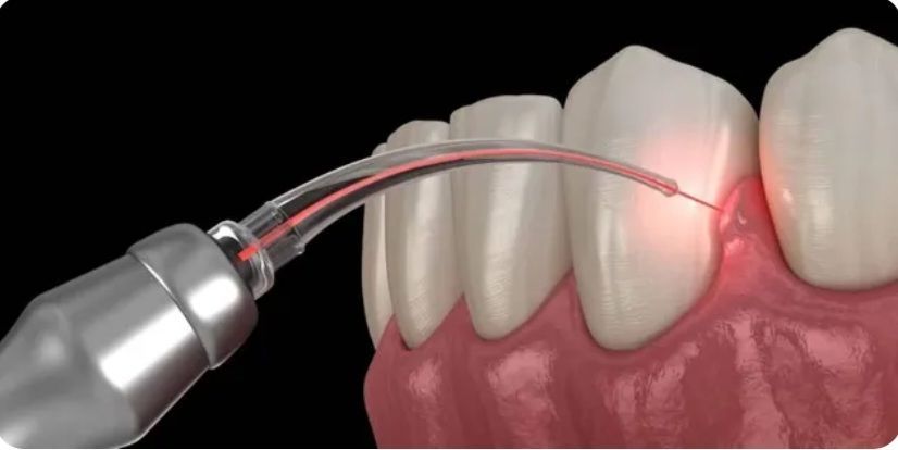 توريد اللثة