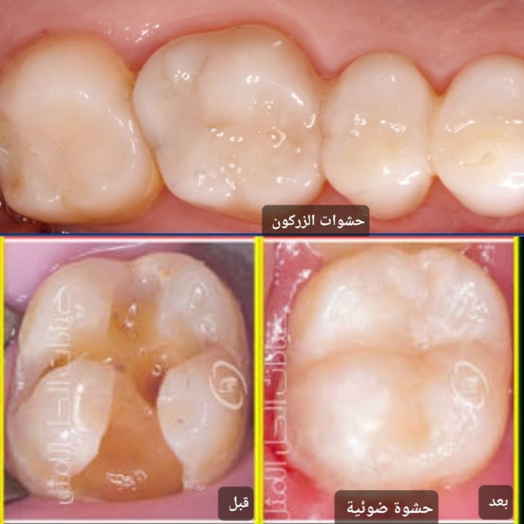 افضل عيادة لحشوات الاسنان
