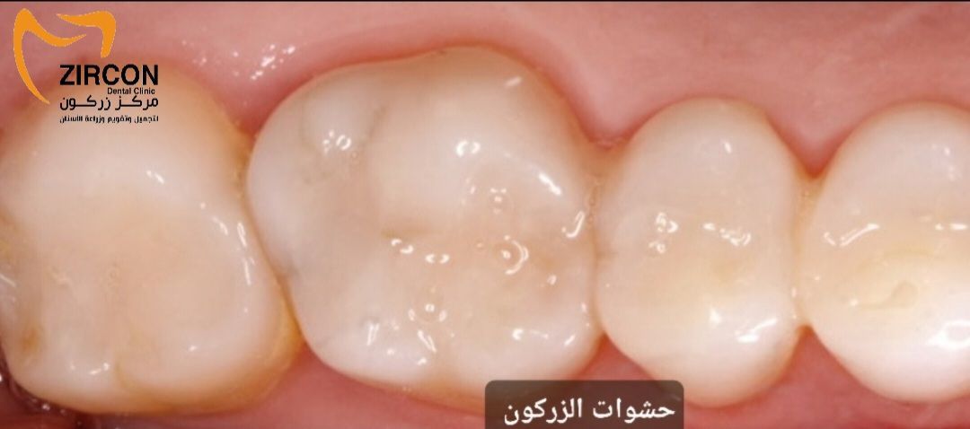 حشوات الزركون