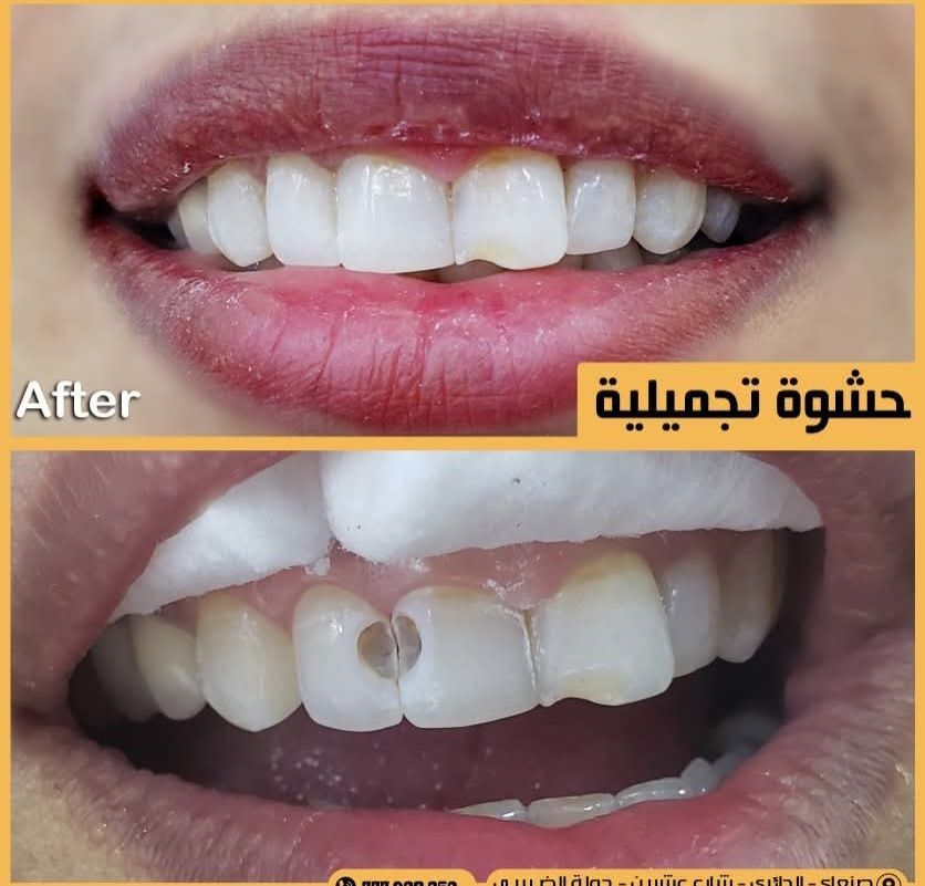 Cosmetic Filling Anatomy