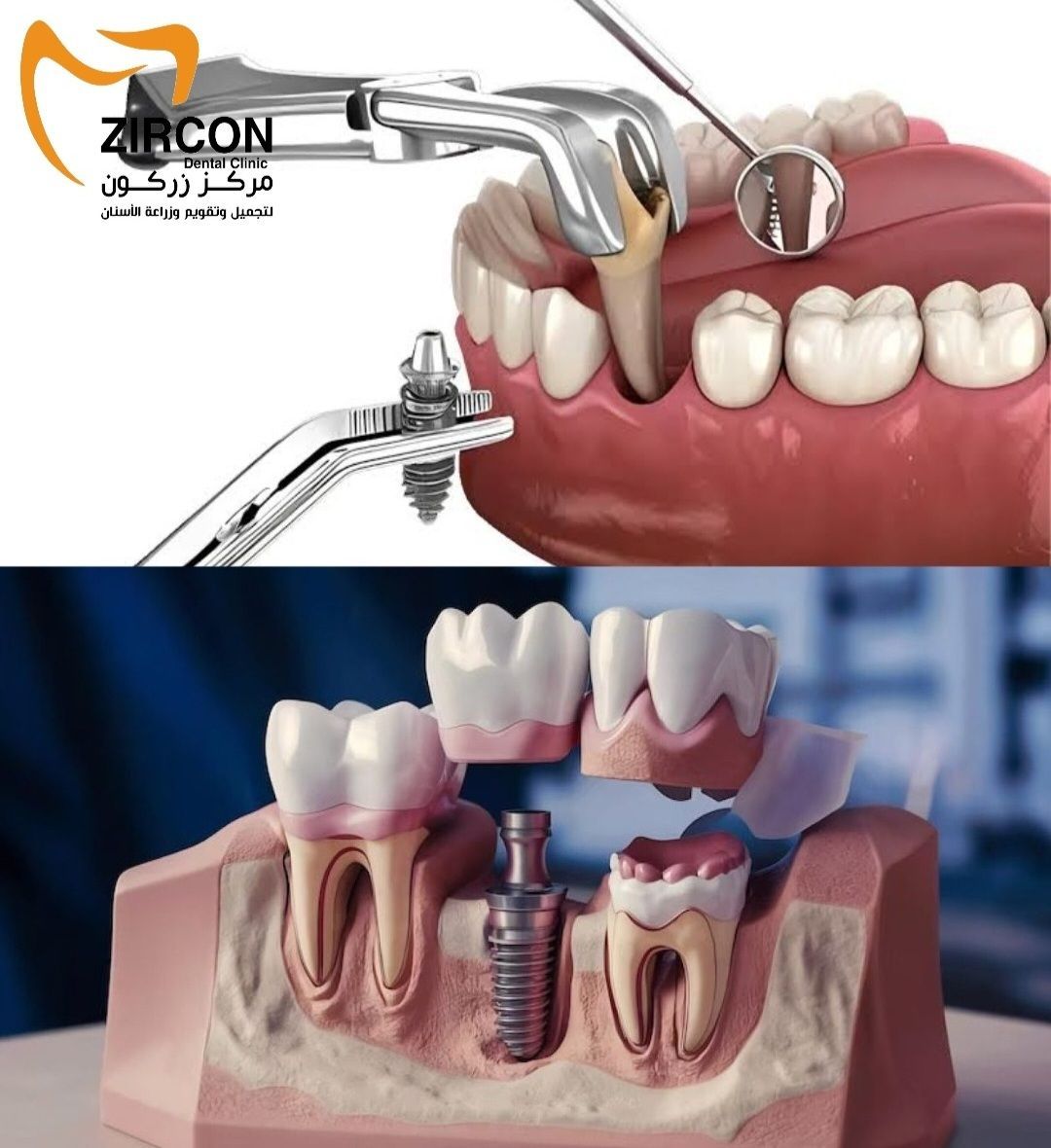 Clear Aligners Technology