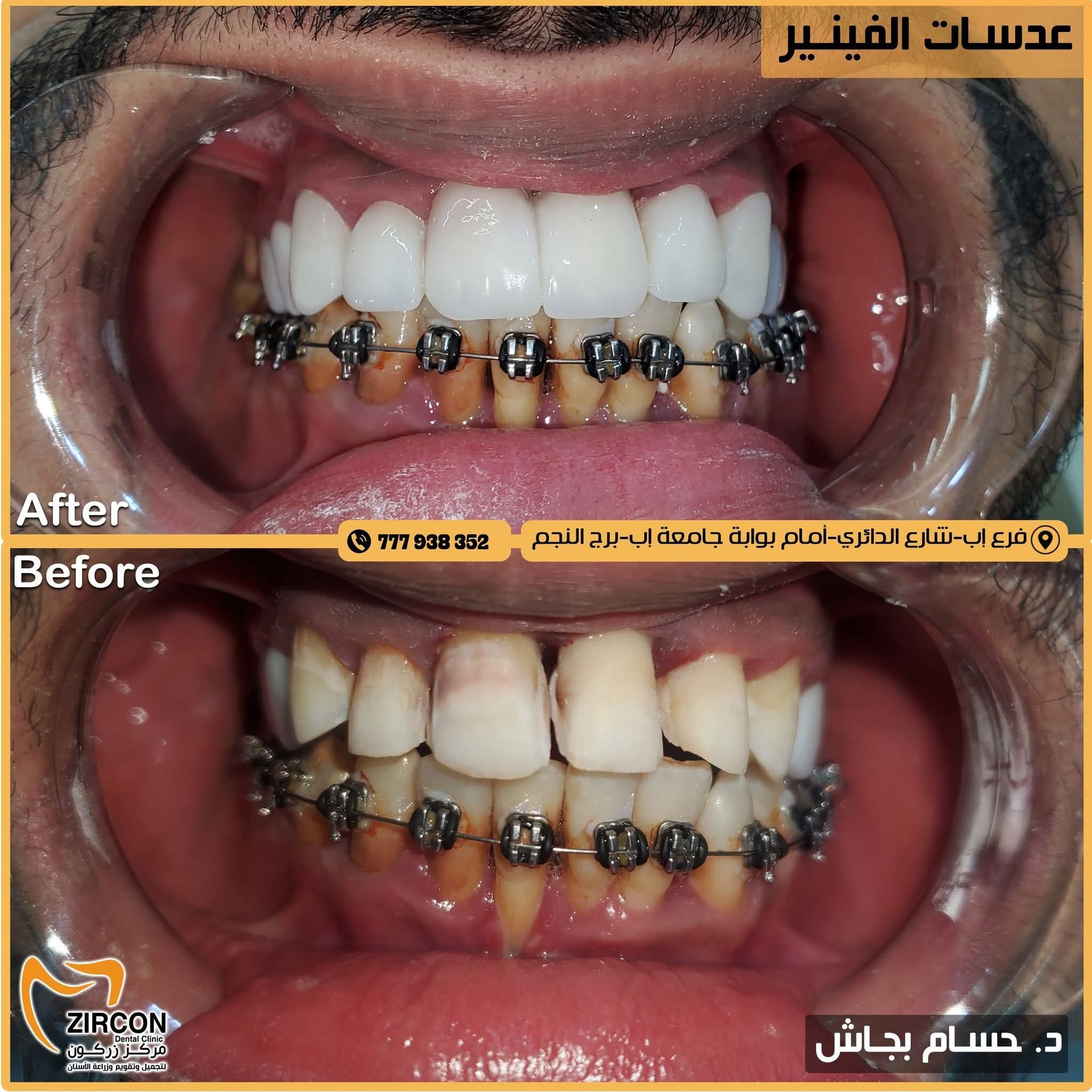 عدسات الفينير لا تحتاج لبرد الاسنان