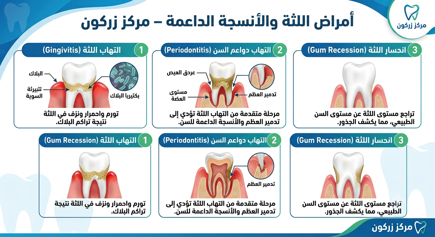 علاج اللثة وتنظيف الأسنان الشامل بمركز زركون