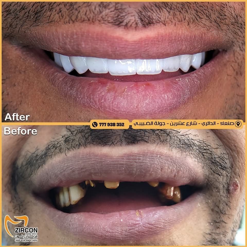 حالة قبل وبعد زراعة وتجميل الأسنان