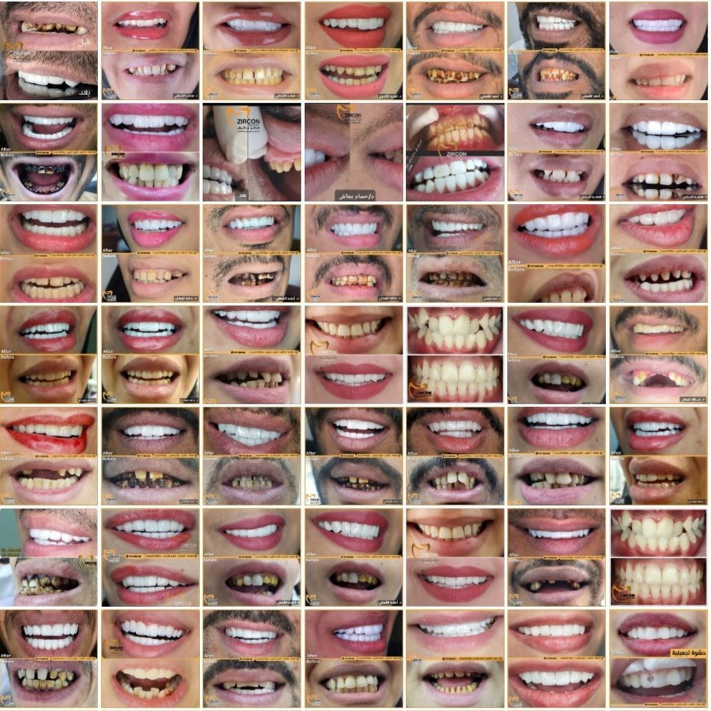 نتائج تجميل الأسنان وعرض الحالات قبل وبعد