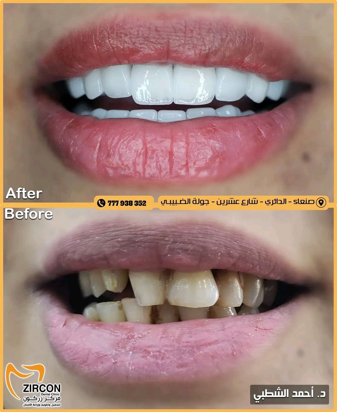 صورة قبل وبعد تلبيسات الزركون 2