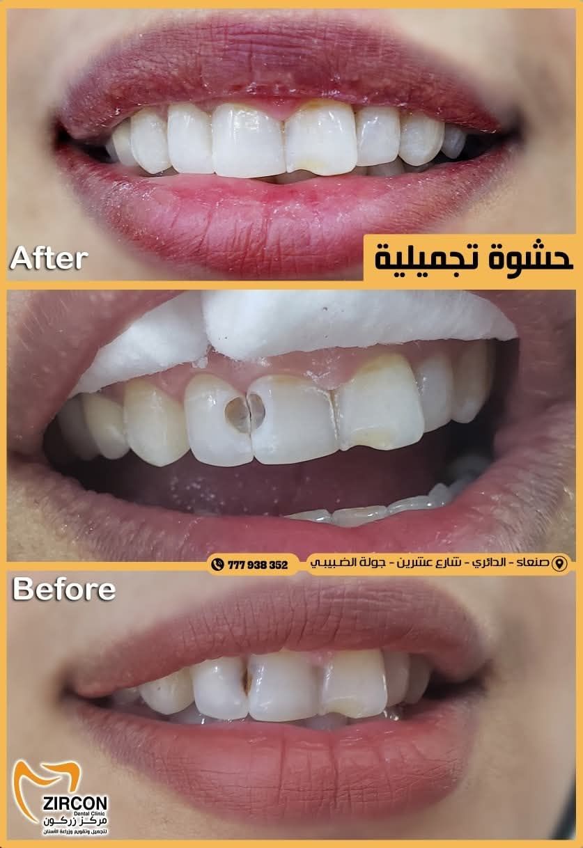 الحشوات التجميلية