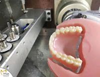 نتائج تقنية CAD/CAM لابتسامة هوليوود