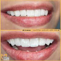 مركز زركون CadCam