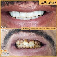 مركز زركون كاد كام - تبييض الأسنان بالليزر في صنعاء اليمن