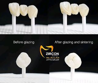 زركون للأسنان