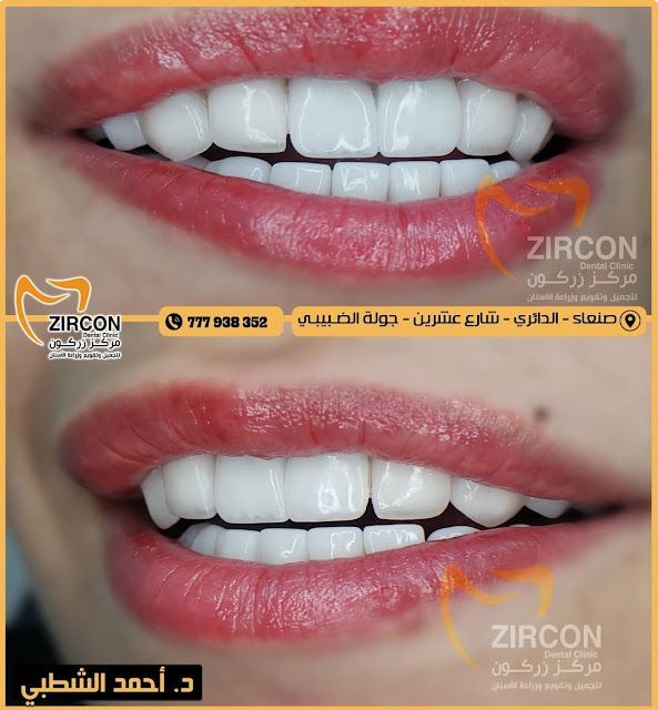 مركز زركون لطب الأسنان