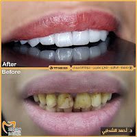 صور قبل وبعد تجميل الأسنان بالزركون في مركز زركون CadCam - تبين تغييرًا جذريًا من تصبغات وتآكل إلى ابتسامة بيضاء ناصعة