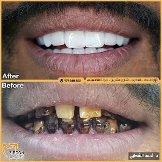 صورة بعد المعالجة