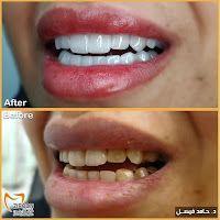 عملية الزركون