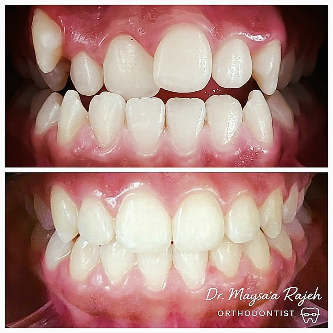 تقويم الأسنان