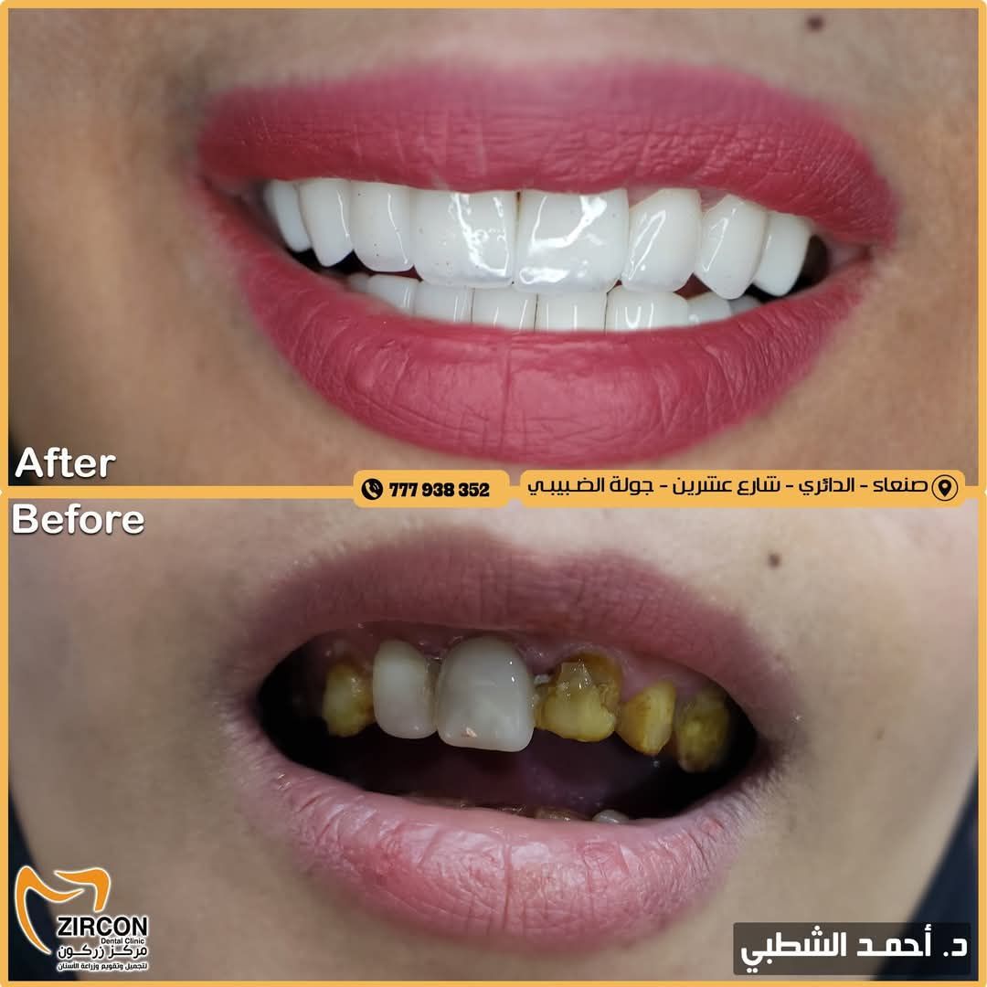 تقنيات طب الأسنان الحديثة في مركز زركون