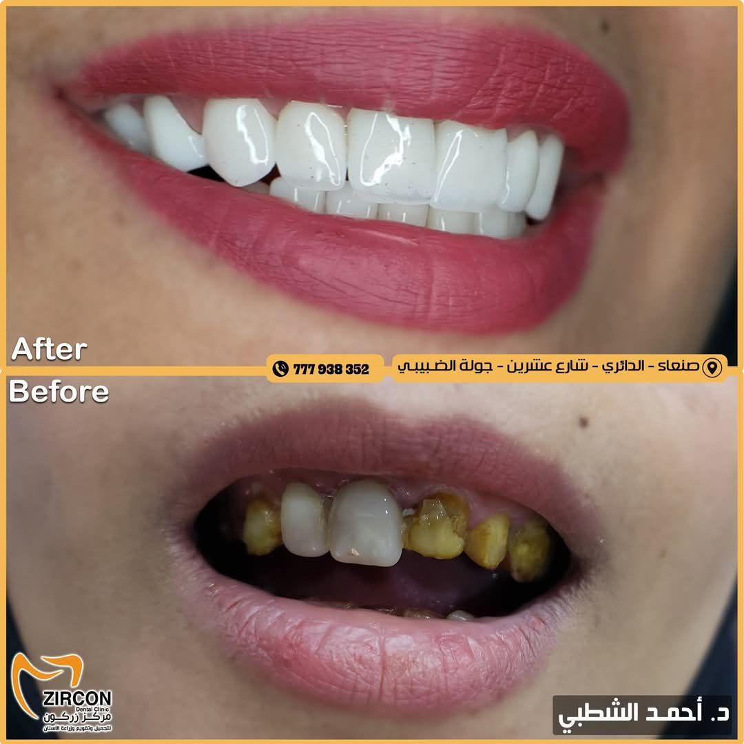 قبل وبعد علاج الأسنان في مركز زركون
