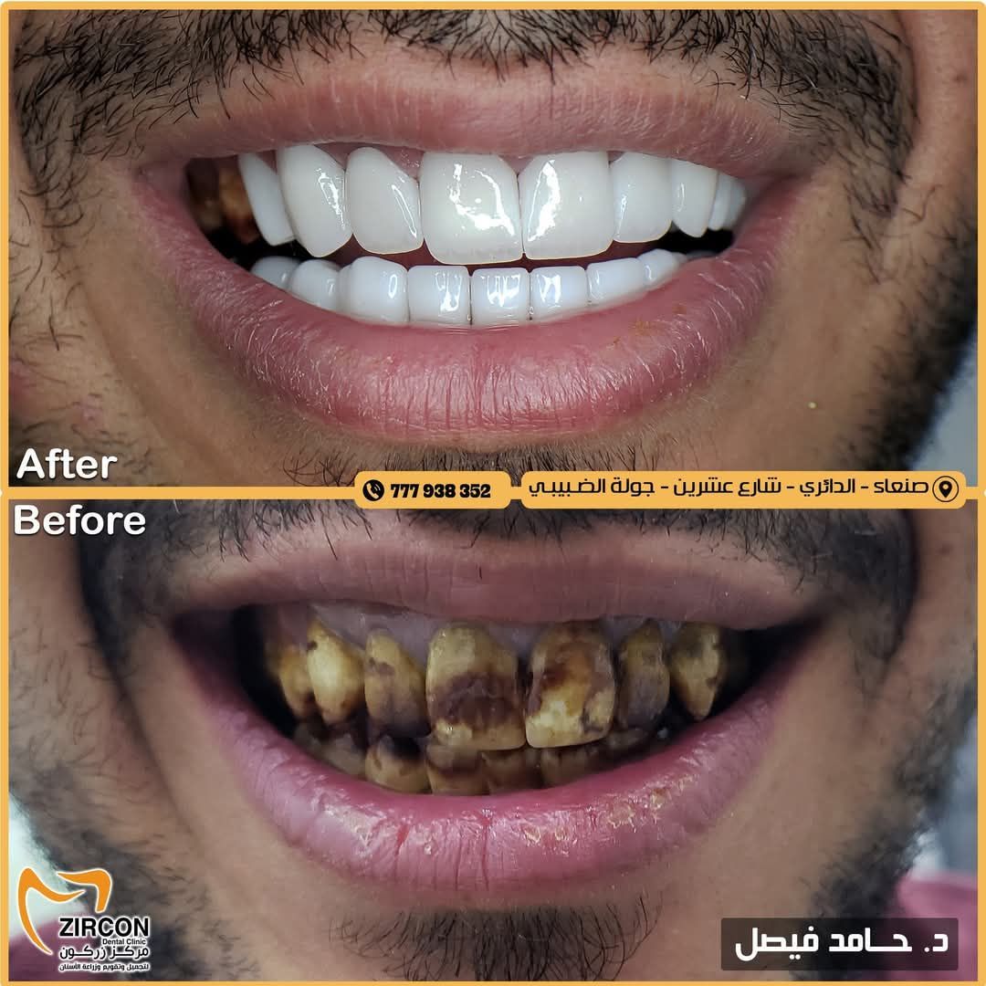 قبل وبعد العلاج