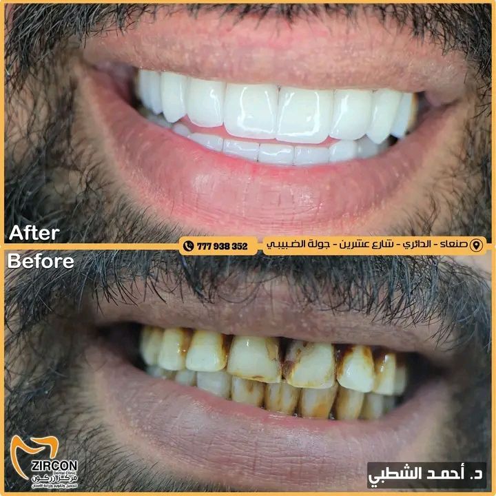 نتيجة تلبيسات الزركون