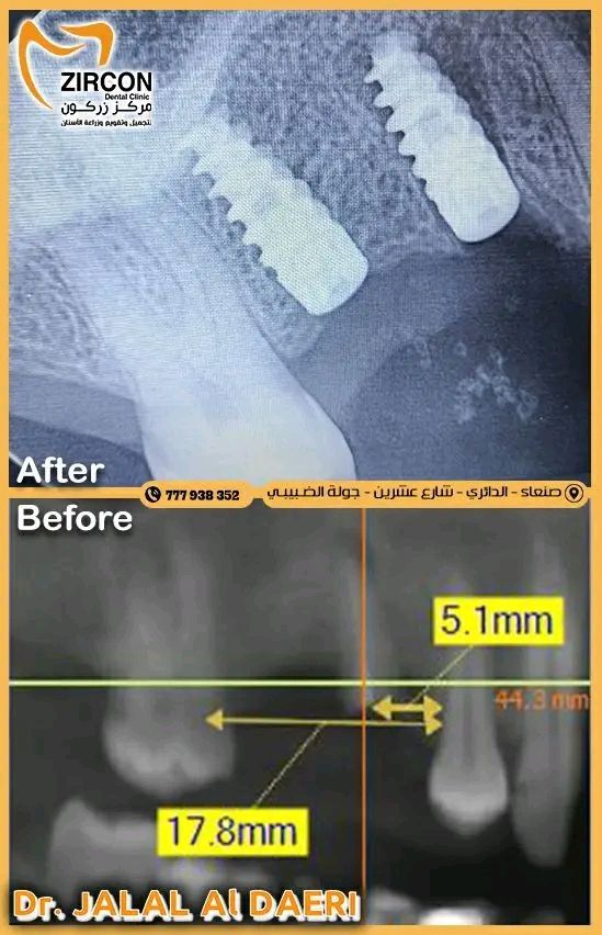 الزراعة الفورية للأسنان