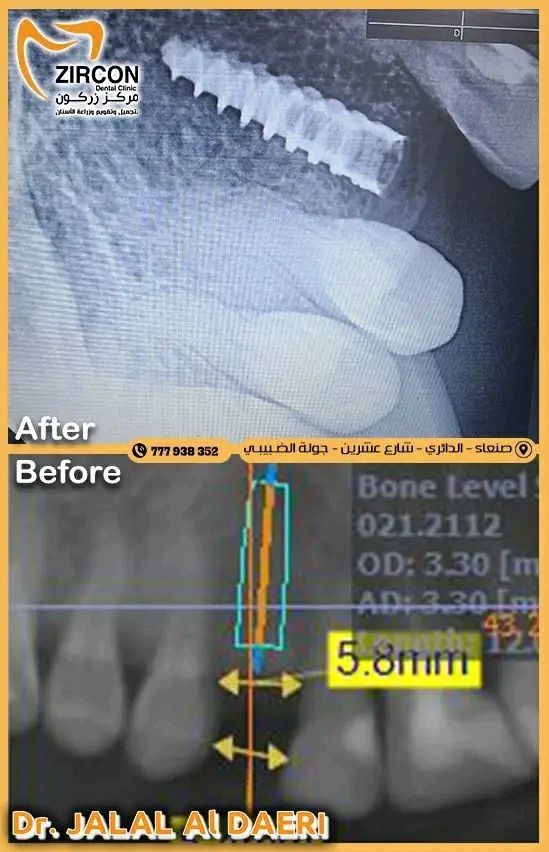 زراعة سن ناب