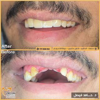 صورة حالة تلبيسات زركون عالية الدقة