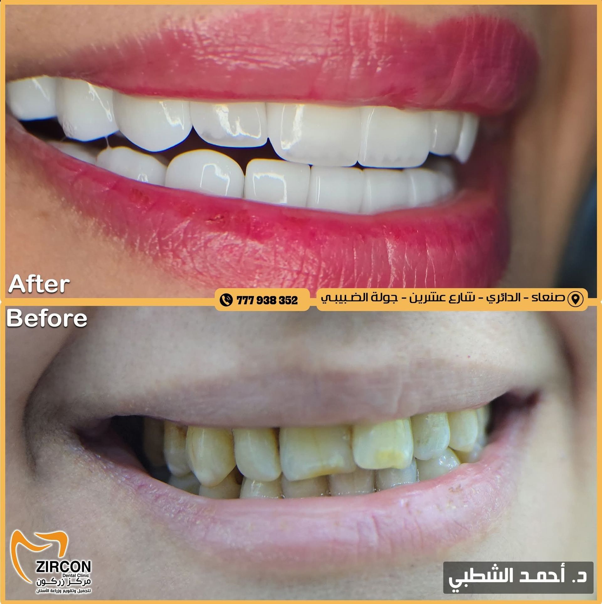 صورة قبل وبعد تلبيسات الزركون للدكتور أحمد الشطبي