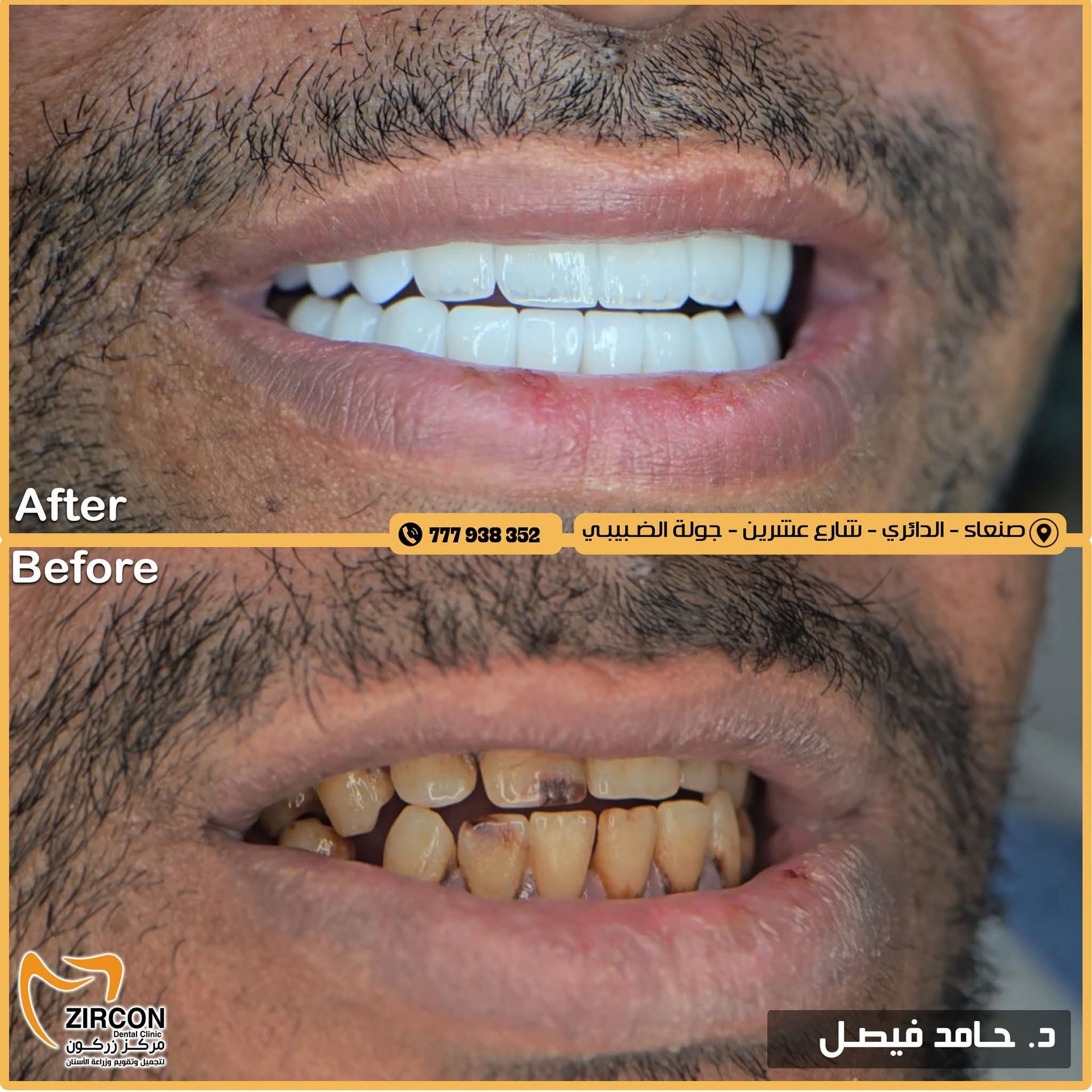 صورة قبل وبعد تلبيسات الزركون للدكتور حامد فيصل