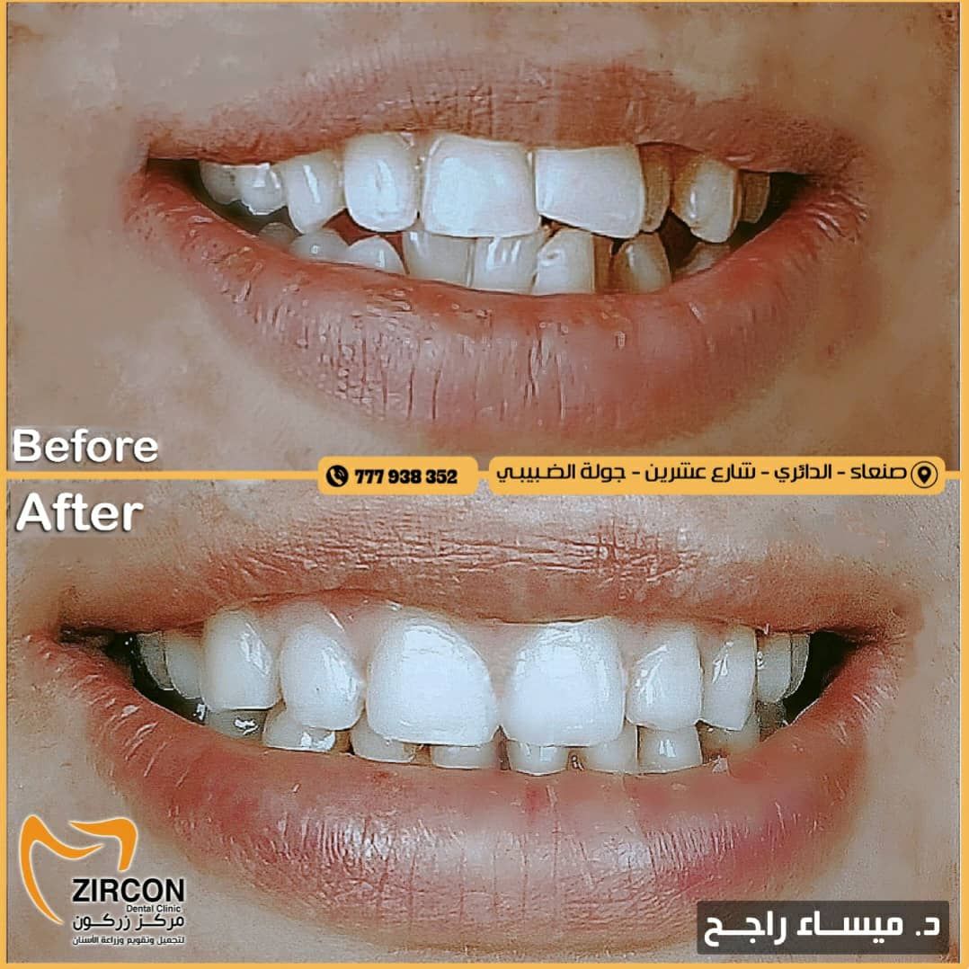 علاج بروز الأسنان