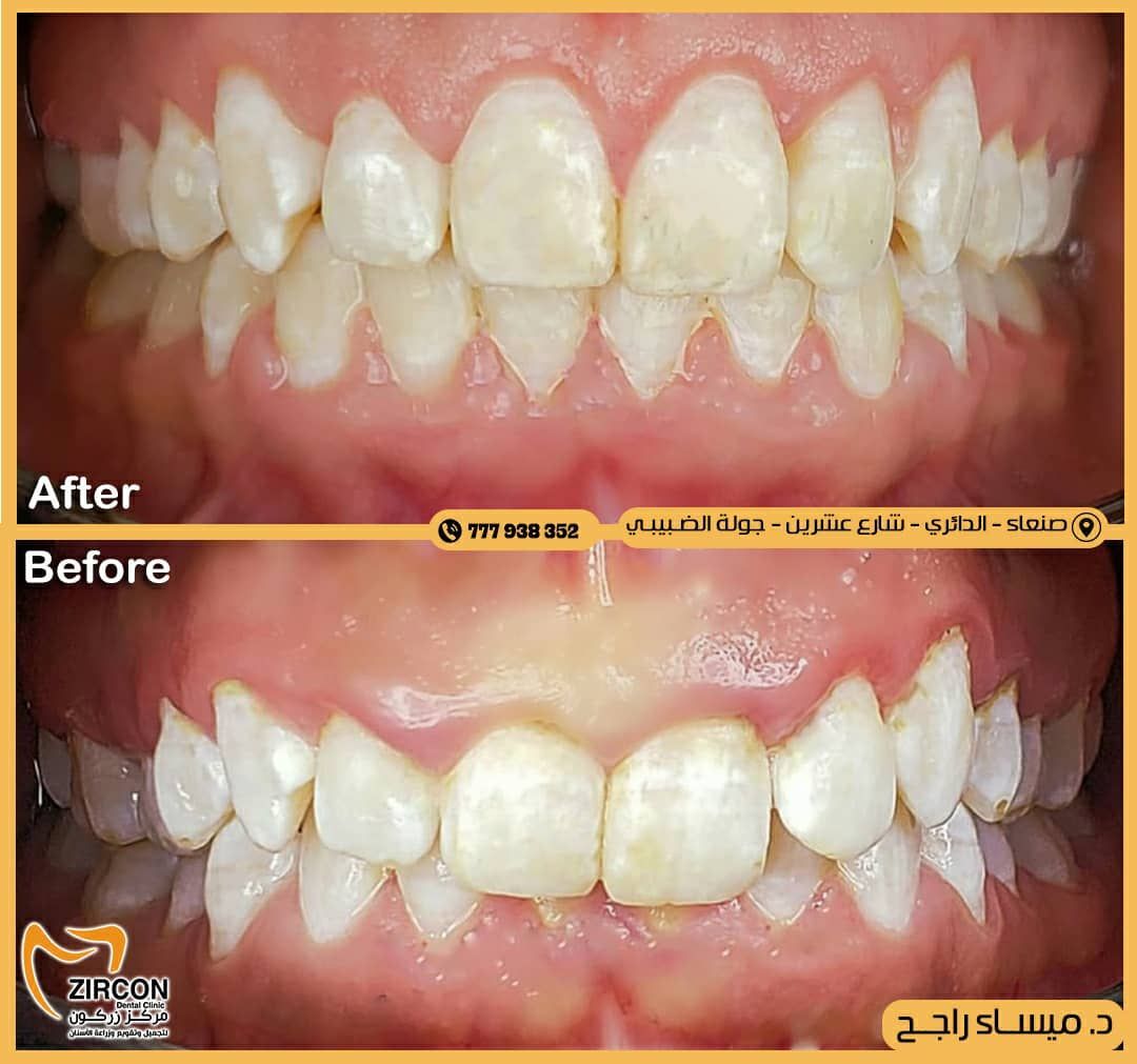 تحول الابتسامة