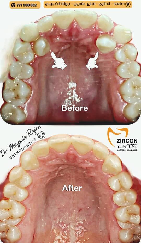 إغلاق الفراغات