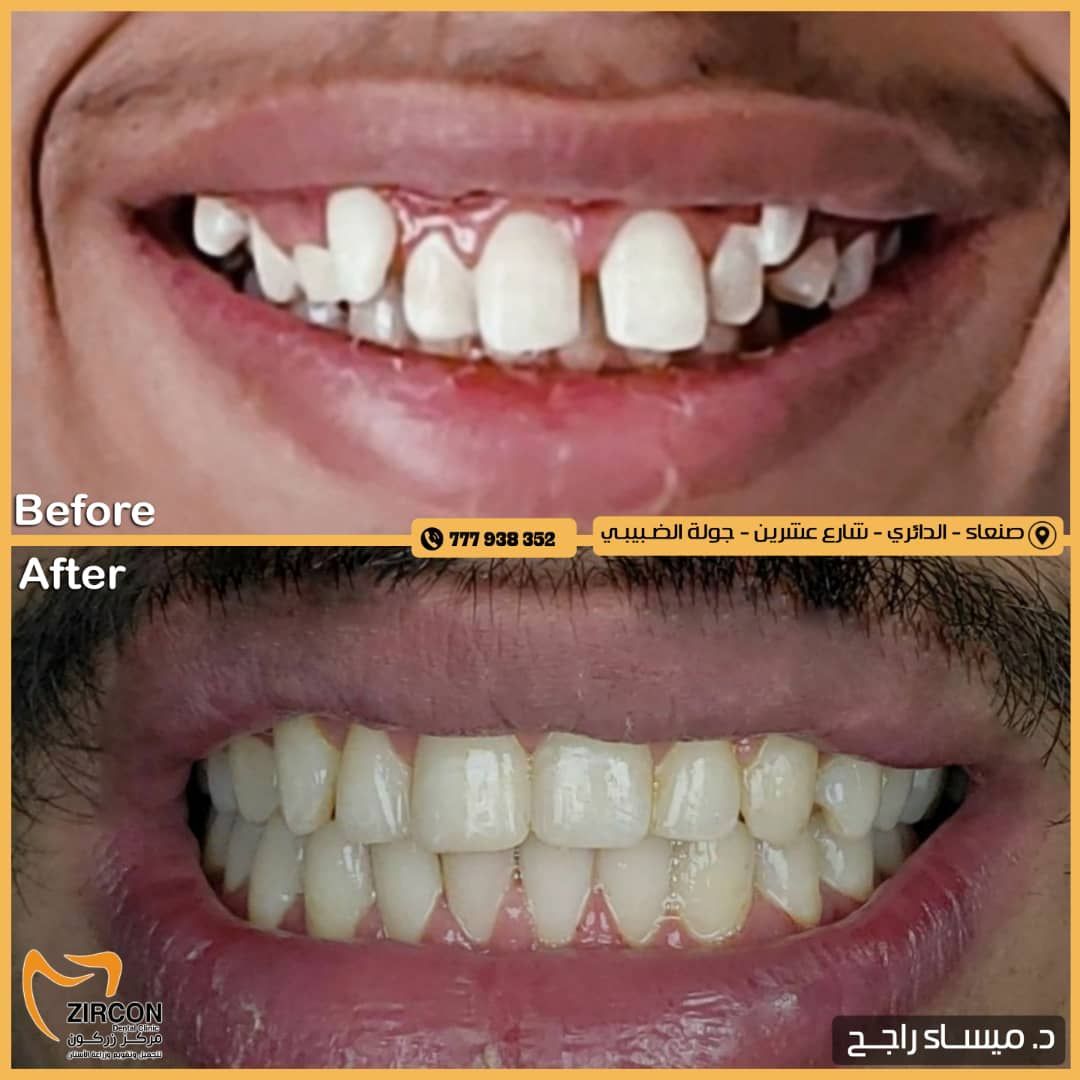 تصحيح الإطباق