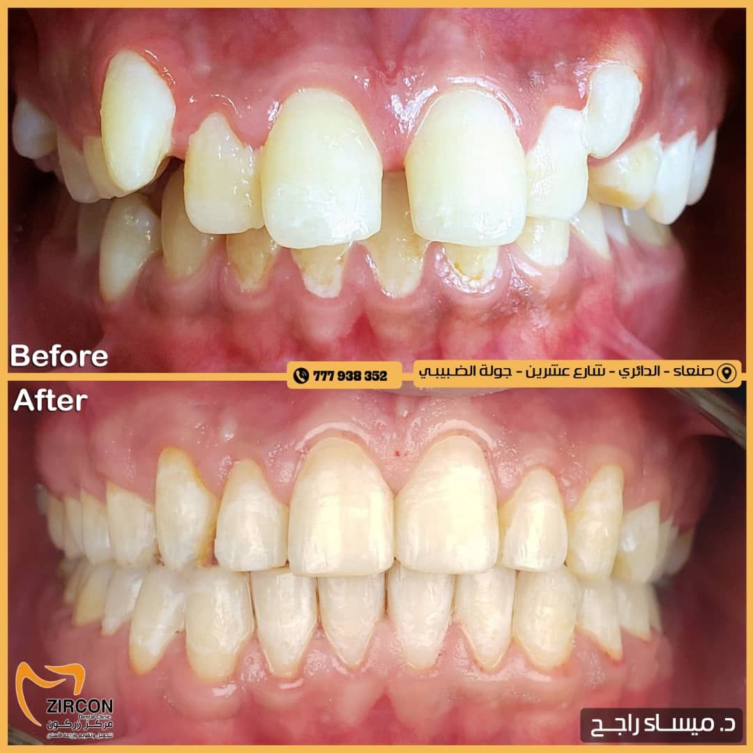 محاذاة الأسنان