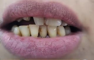 نتائج زراعة الأسنان وتجميلها في مركز زركون - قبل وبعد