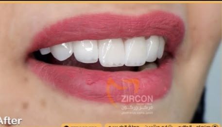 منتج زركون عالي الجودة