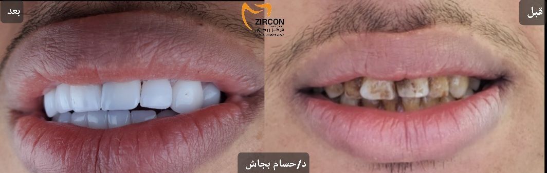 ابتسامة هوليود بالزركون - دكتور حسام بجاش - مركز زركون