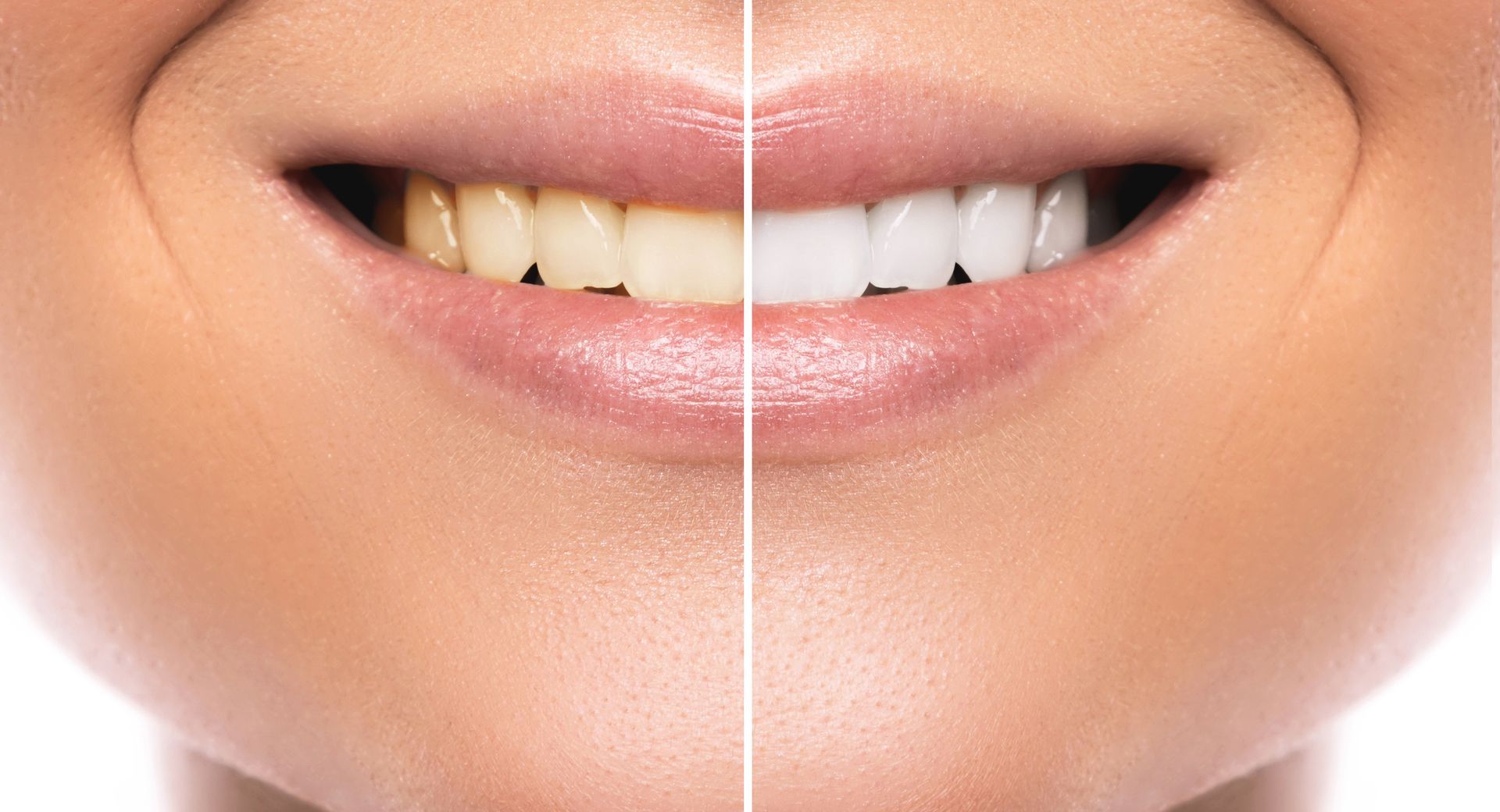 Gros plan sur une bouche souriante divisée par une ligne verticale, montrant des dents naturelles d'un côté et des dents d'un blanc éclatant de l'autre.
