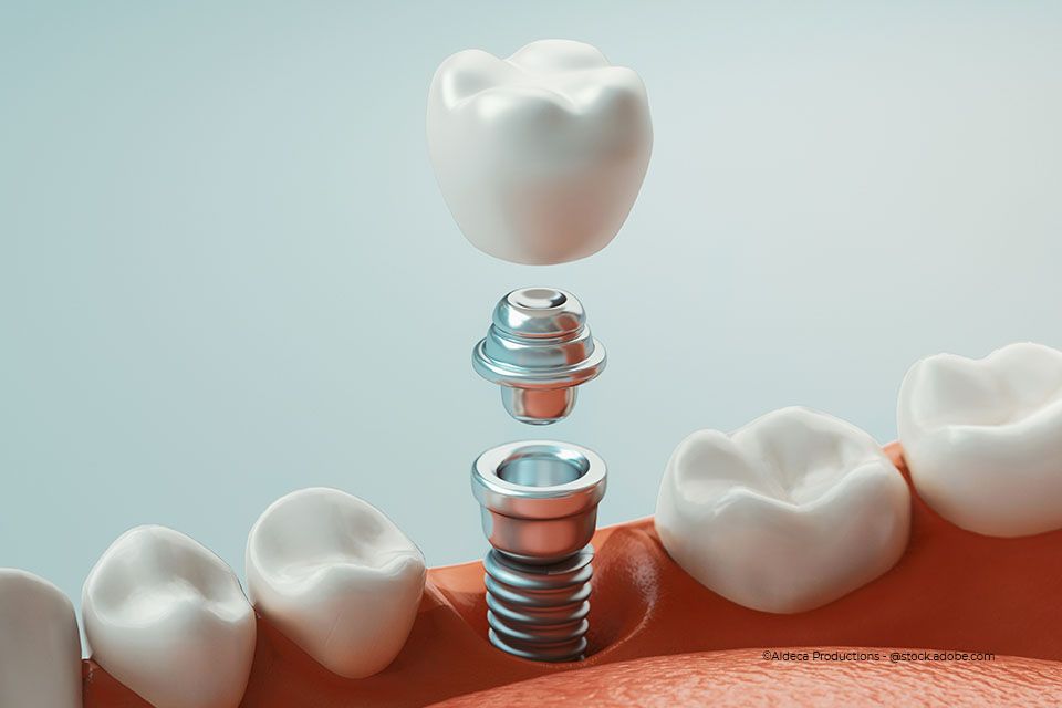 Darstellung eines Zahnimplantats in der Zahnarztpraxis Hartmann