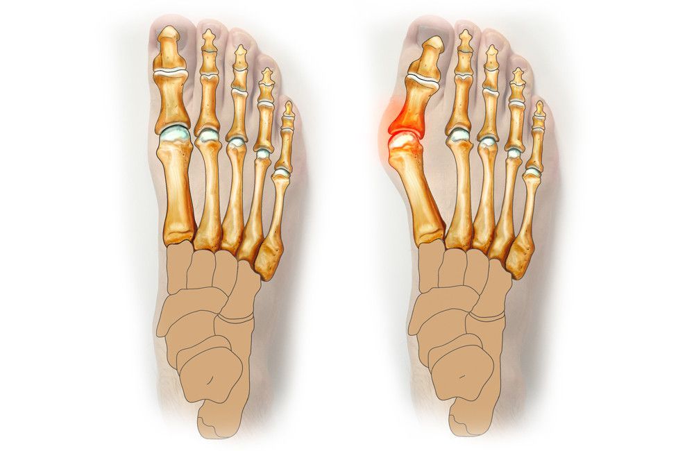 Hallus Valgus, Kotsi, Blaisos Megas Daktylos, Podi ponos