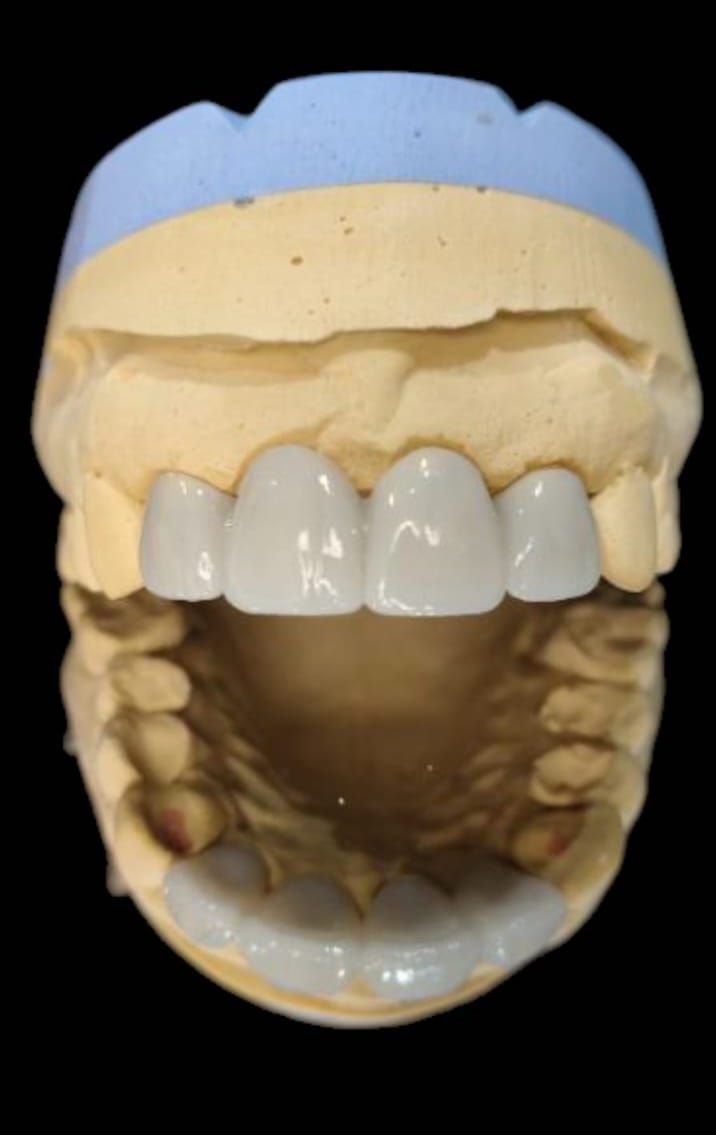 Modelo dental que muestra un puente de dientes artificiales; tonos azul pálido, beige y blanco.