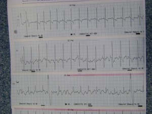 Tres hojas de papel de ECG que muestran los latidos del corazón de una persona.